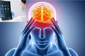 Beyin Tümörü Ameliyatı: Baş Ağrısından Erken Tanıya Giden Yol