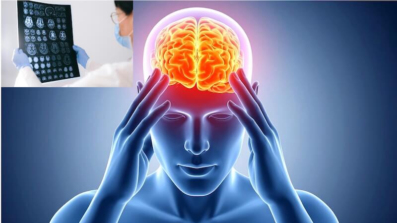 Beyin Tümörü Ameliyatı: Baş Ağrısından Erken Tanıya Giden Yol
